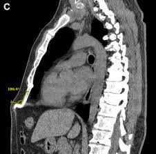 142 Xiphoid Process Images, Stock Photos, 3D Objects, & Vectors |  Shutterstock