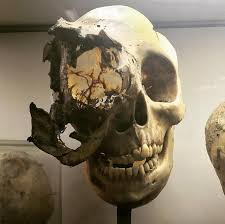 The Skull Of A Person With The Rare Type Of Bone Cancer Chordoma Wtf