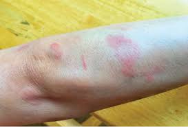 Antiphospholipid Antibody Syndrome Much Remains To Be Learned The Rheumatologist