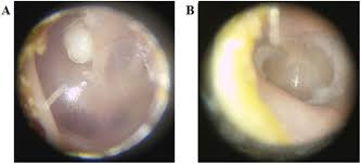 Image result for Myringosclerosis
