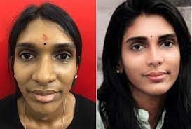 Since cosmetic nose surgery is highly customized, the cost can vary a lot depending on the surgical plan. Rhinoplasty Surgery Cost In India Richardson Craniofacial Hospital