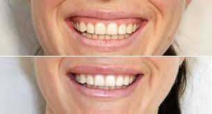 Maybe you would like to learn more about one of these? Gummy Smile Santa Barbara Botox Injections Sb Aesthetics