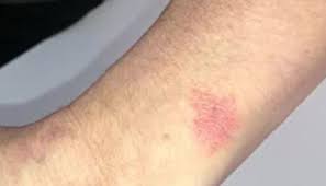 It is impossible to be allergic to nitrogen. Fitbit Caused Skin Irritation Wisconsin Women Claim