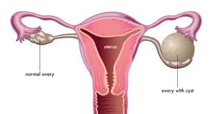 Kista Merupakan Sejenis Tumor Jinak Yang Menyerupai Kantung Yang Berisi Cairan Kental Cairan Tersebut Dapat B Ovarian Cyst Cyst On Ovary Ovarian Cyst Symptoms