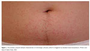 Image result for Exercise-Induced Anaphylaxis