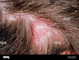 Image result for Tinea Capitis