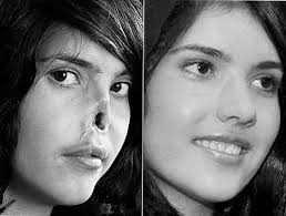 Bibi Aish's Pain isn't Over