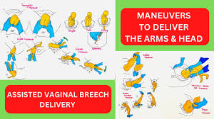 Image result for Breech Delivery
