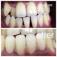 Crowns And Bridges Can Be Improve A Tooth Wellness Alignment Bitting And Shape Gaps Left By Missing Teeth Can Cause The Remain Fix Teeth Dental Bridge Dental