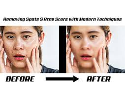 Forehead Pimples Projekter :: Photos, videos, logos, illustrations and  branding :: Behance