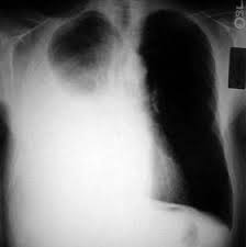 Болтовня (to listen someone's effusions tyrese123). Pleural Effusion Background Anatomy Etiology
