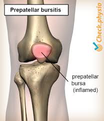 Image result for Prepatellar Bursitis