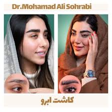 Eyebrow transplantation