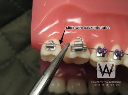 You can fix poking braces wire using one of the following methods: Braces Care Guide Frequently Asked Questions About Braces Grand Rapids Orthodontists