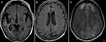 A Neuropsychiatric Analysis Of The Cotard Delusion The Journal Of Neuropsychiatry And Clinical Neurosciences
