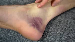 Image result for Contusion