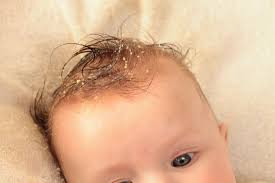 Kopfgneis Umgangssprachlich Milchschorf Entfernen Babyartikel De Magazin