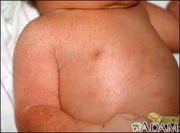 Keeping the baby warm some children tend to experience a severe mottling of skin after having a bath or being in the tub for long durations of time. Skin Findings In Newborns Information Mount Sinai New York