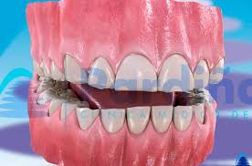 Image result for Tooth Attrition