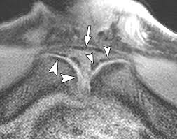 Image result for Pubic Apophysitis