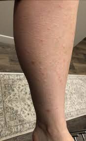 It can cause inflammation, pain and tiny bumps in the area where the hair was removed. No More Irritating Ingrown Hair S With Laser Hair Removal