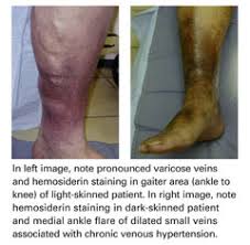 Image result for Lipodermatosclerosis