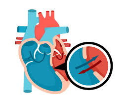 Image result for Ventricular Septal Defect