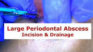 Image result for Periodontal Abscess