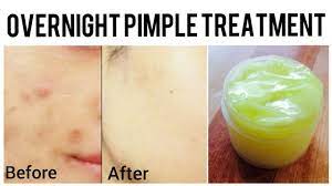 Whisk the two ingredients together until they're combined in a paste. How To Remove Pimples Overnight Homemade Pimple Cream Acne Scar Treatment Youtube