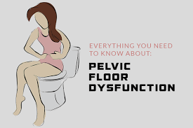 Image result for Pelvic Floor Dysfunction