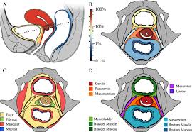 It is not based on what is found during surgery. Roadmap To Local Tumour Growth Insights From Cervical Cancer Scientific Reports