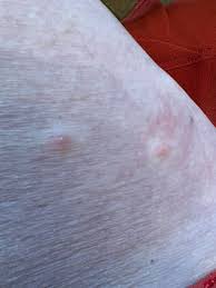 Image result for mite bites on humans