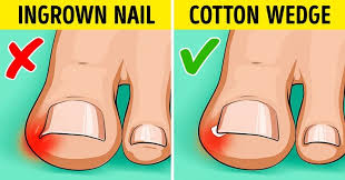 In some cases, ingrown toenails may become infected or even require surgical removal. 9 Effective Ways To Fix Ingrown Toenails