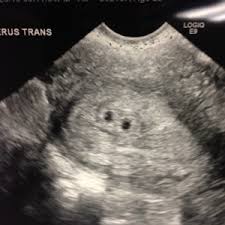 Check spelling or type a new query. Pregnancy 5 Weeks 3 Days Ultrasound Pregnancywalls