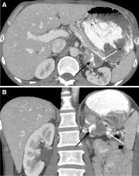 Ct is commonly used to detect and characterize adrenal masses. Adrenal Cortical Adenoma Current Update Imaging Features Atypical Findings And Mimics Springerlink