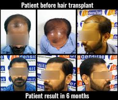 We use only the best technology on the market and our staff is highly trained, certified, and insured to work in the cincinnati area. Best Hair Transplant In Kochi Kerala La Densitae