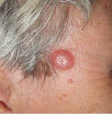 Image result for Nodule