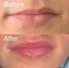Needleless lip fillers procedures are simple and easy, and can be used in combination with other injectables or lip augmentation treatments over the course of multiple treatments. Local Salon Launches New Needle Free Lip Filler Service In Lincoln