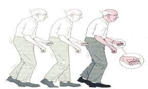 El temblor esencial y el parkinson. Sintomas Clasicos De La Enfermedad De Parkinson Rigidez Temblor Download Scientific Diagram