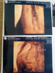 Pemeriksaan ultrasonografi (usg) adalah hal yang sangat dianjurkan untuk perempuan hamil. Jenis Kelamin Hasil Gambar Usg Bayi Laki Laki