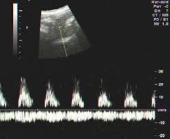 Spectral Doppler Waveform Of Umbilical Artery In Intrauterine Growth Retardation Iugr Demonstrates Loss Of Diastolic Flow Pulsati Fetal Doppler Fetal Growth