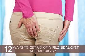 How To Get Rid Of A Pilonidal Cyst Without Surgery Hemorrhoids Treatment