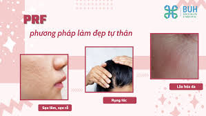 PRF - BƯỚC TIẾN MỚI TRONG TRẺ HÓA DA, LÀM ĐẸP TỰ THÂN BUH