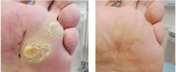 Warts are typically small, rough, hard growths that are similar in color to the rest of the skin. Swift Microwave Podiatry First