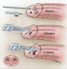 Image result for Priapism