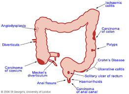 Image result for Small Intestinal Bleeding