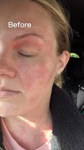 💉Your lips just enhanced, never overdone. Leanne and Laura have been  diligently addressing the increasing demand for lip enhancements within our  clinic. Utilising only licensed, medical-grade dermal fillers, each  treatment is meticulously