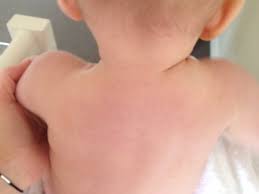 Portuguese english english portuguese german english english german dutch english english dutch Lumps Bruise On Shoulder March 2014 Babycenter Australia