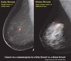 What does breast cancer look like on a mammogram? Fibroglandular Densities Mammographic Breast Density Itn