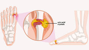 10 Common Foot Problems And How To Manage Them Everyday Health